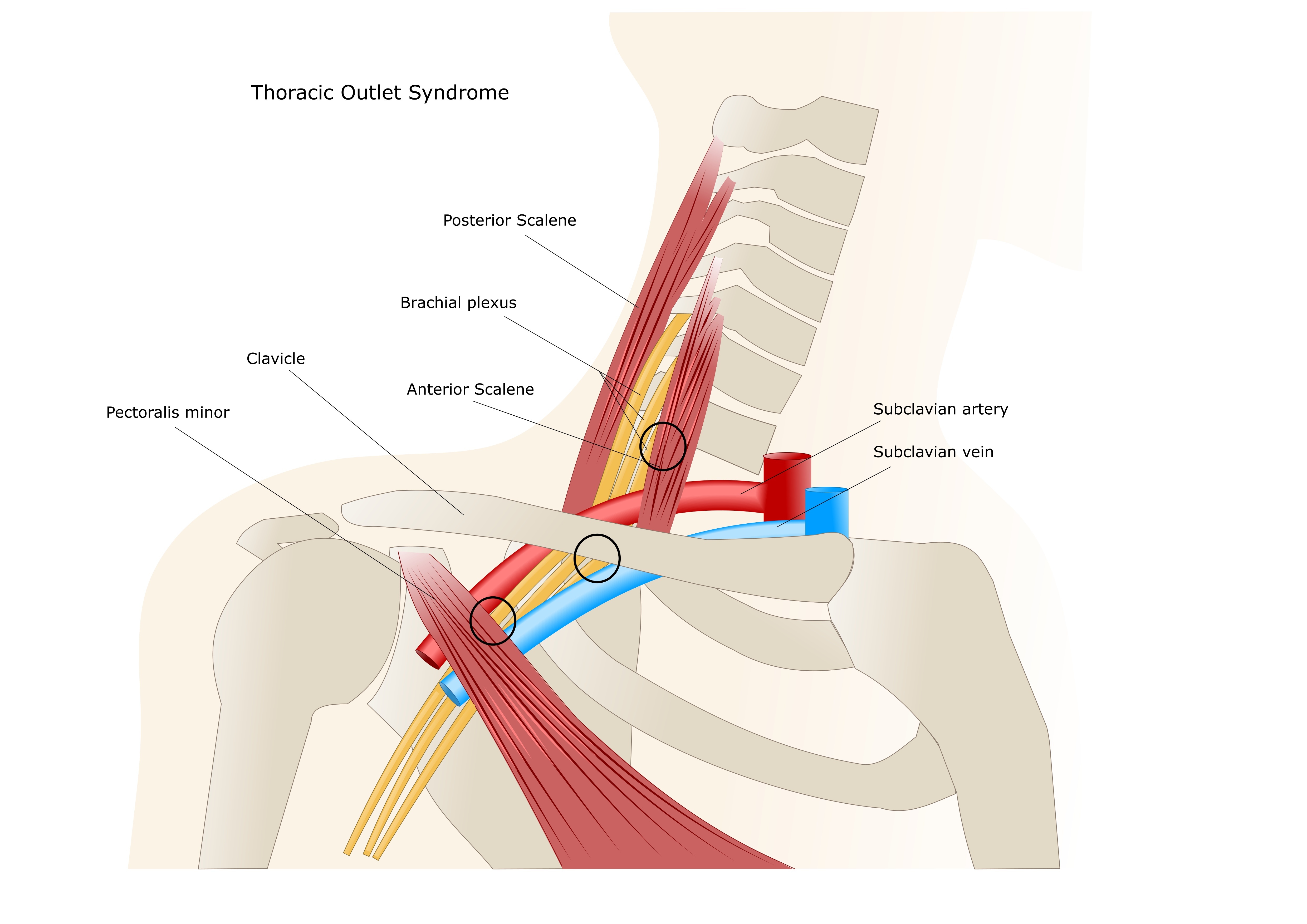 thoracic outlet syndrom.jpg