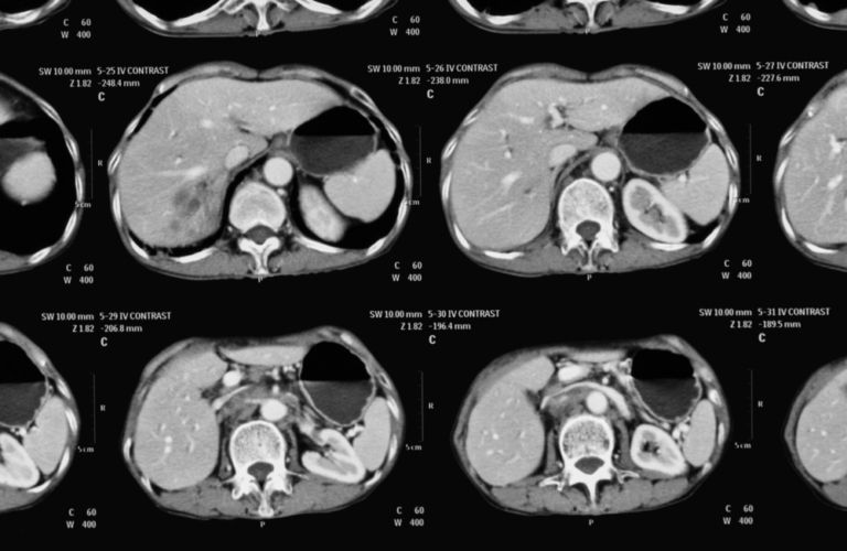 Hepatic Adenoma Liver Lesions