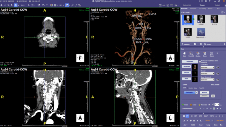 Expand Services with On-Demand Access to TeraRecon Advanced Visualization Tools